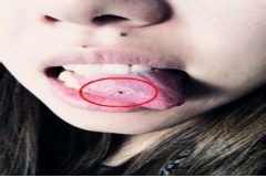 舌头有痣代表什么意思